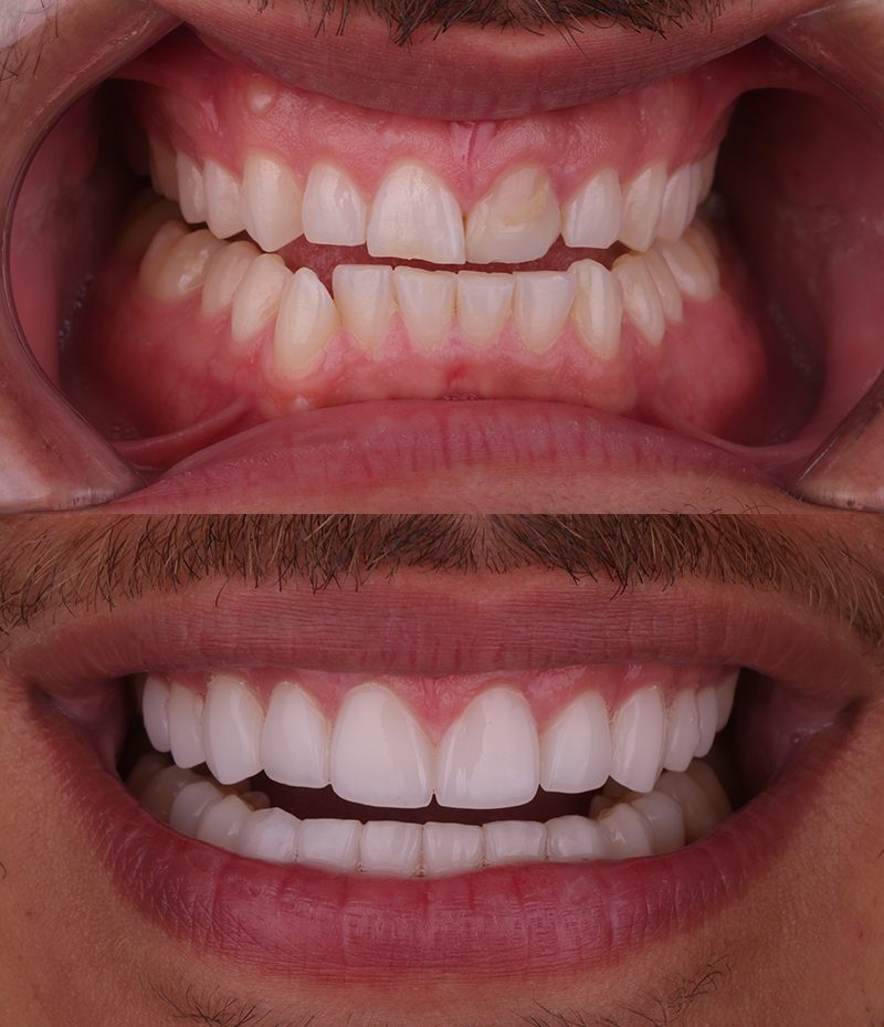 Teeth Straightening Before and After in Santa Monica - Santa Monica Dental Studio