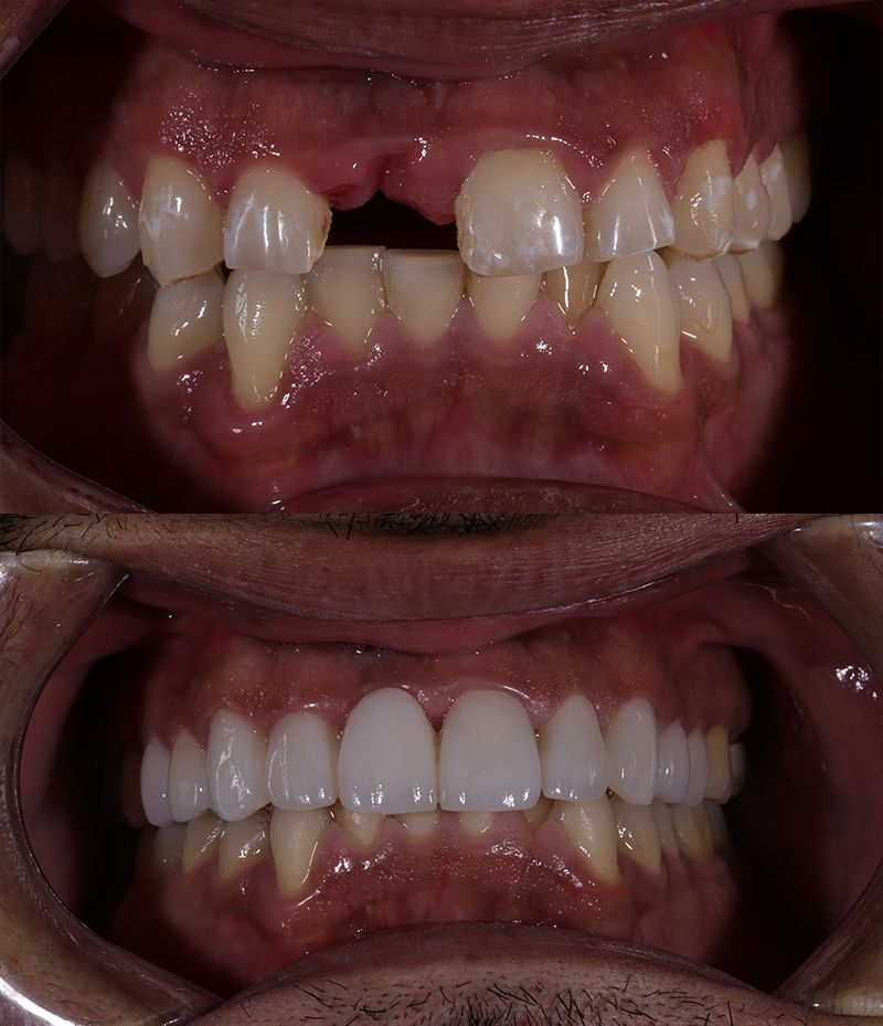Dental Implant Before and After in Santa Monica - Santa Monica Dental Studio