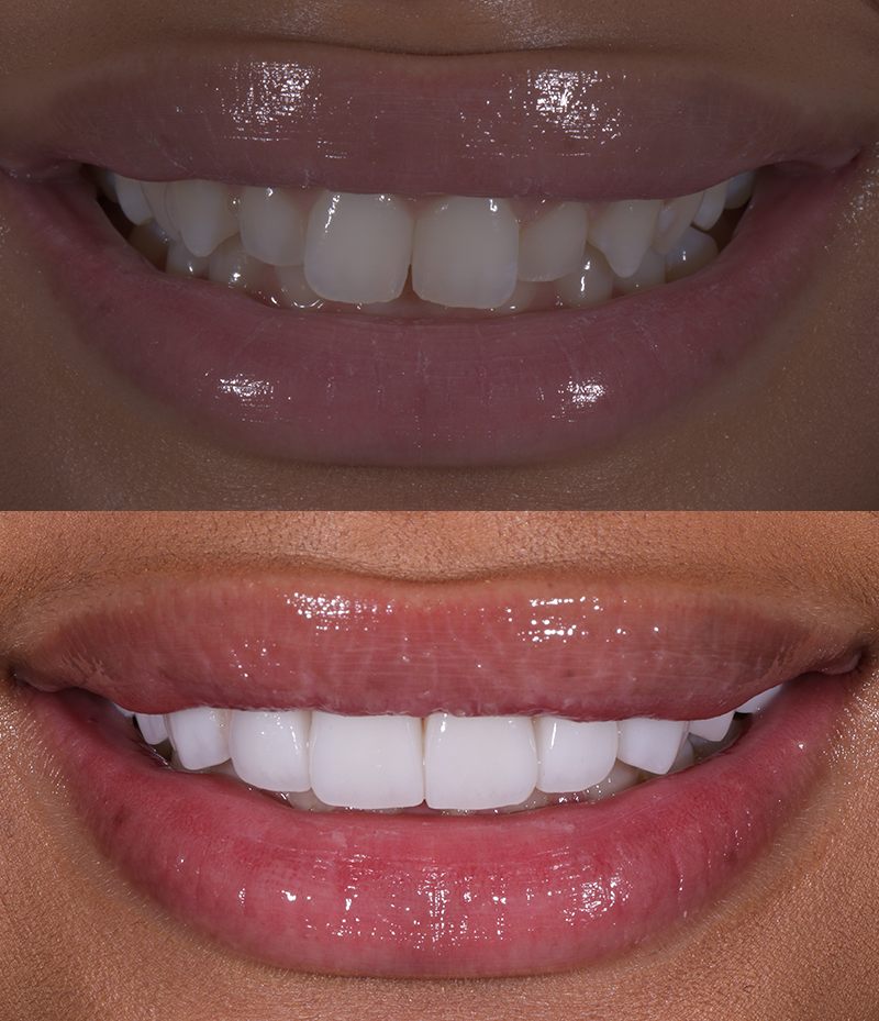 Porcelain Veneers Before and After in Santa Monica - Santa Monica Dental Studio