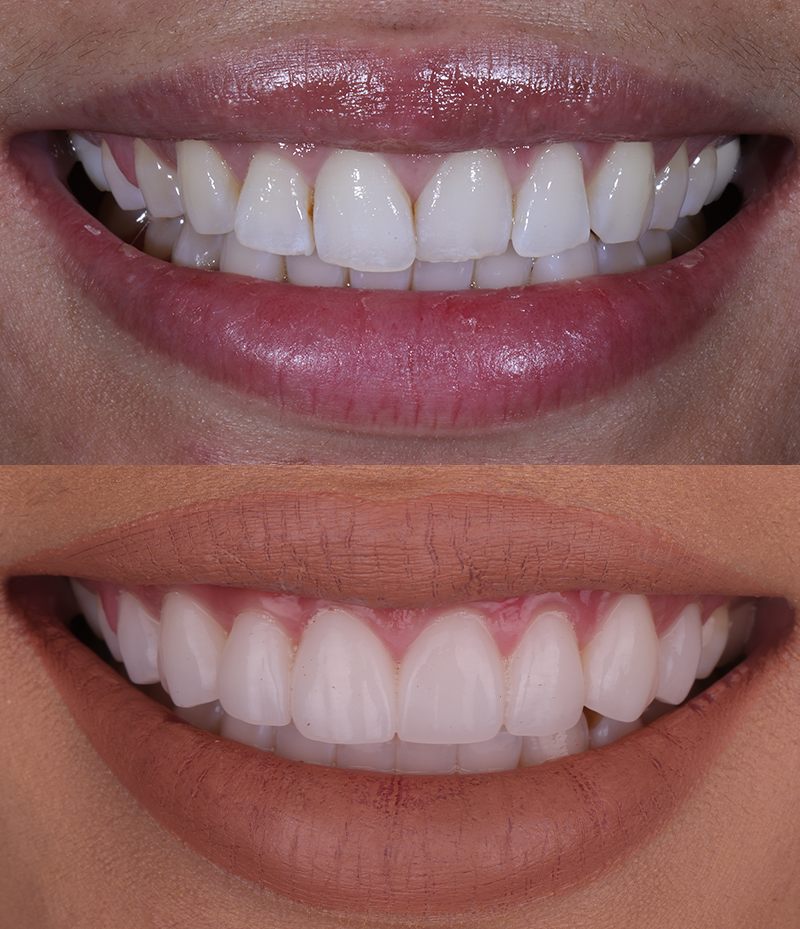 Teeth Whitening Before and After in Santa Monica - Santa Monica Dental Studio