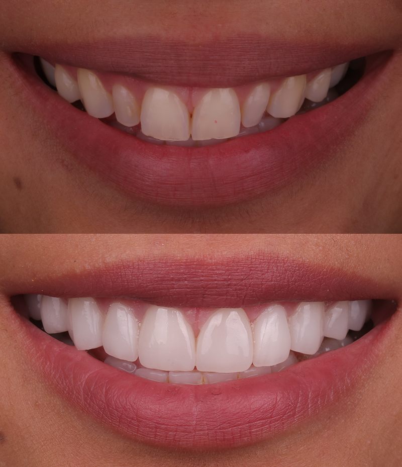 Cosmetic Dentistry Smile Makeover Before and After in Santa Monica - Santa Monica Dental Studio