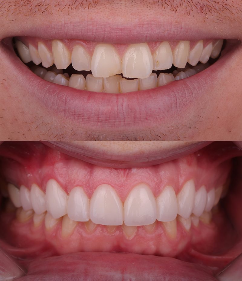 Dental Crown Before and After in Santa Monica - Santa Monica Dental Studio