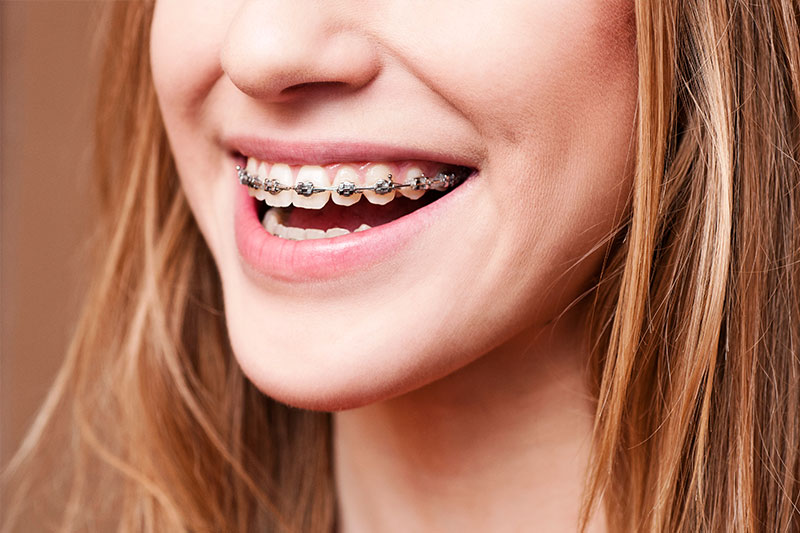Orthodontics in Santa Monica