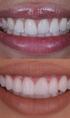 Before and after: Porcelain Veneers