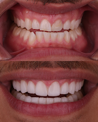 Before and after: Smile Makeover