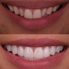 Before and after: Cosmetic Bonding