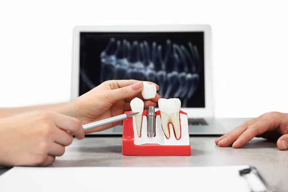 Implants vs. Dentures: What Works Best for Missing Teeth?